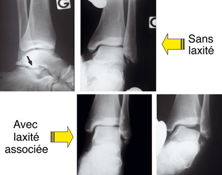 Ligamentoplastie Centre Orthop dique Pasteur Lanroze